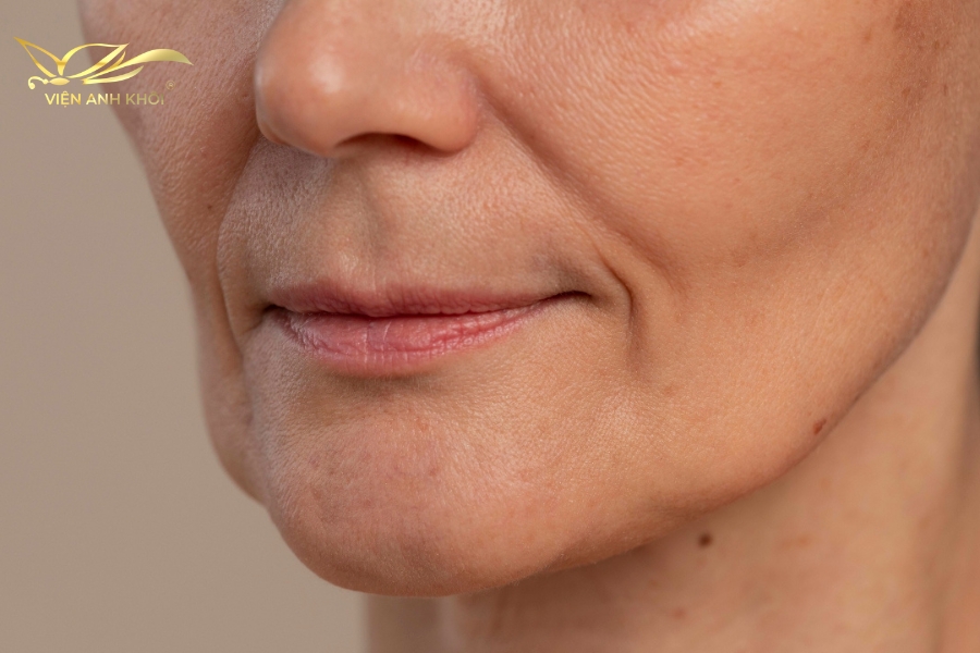 Các nếp nhăn rãnh mũi má trên mặt là một trong những vấn đề về làn da thường gặp ở phụ nữ. Đây là một hiện tượng tự nhiên, nhưng lại khiến cho nhiều phụ nữ lo lắng
