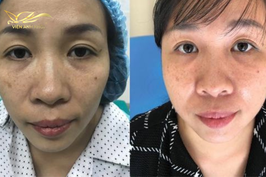 Khách trước và sau khi cấy chỉ hốc mắt