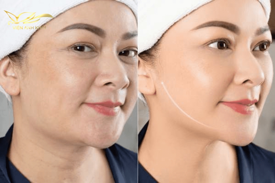 Khi làn da bắt đầu trở nên lão hóa, phái đẹp thường tìm đến phương pháp căng chỉ collagen để cải thiện tình trạng làn da