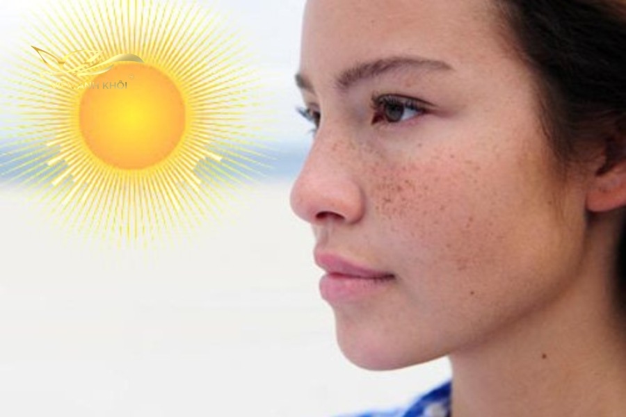 Tiếp xúc nhiều với ánh nắng mặt trời là nguyên nhân hàng đầu gây nám tàn nhang