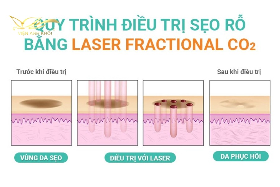 Tái tạo bề mặt da bằng laser là một phương pháp điều trị sẹo rỗ lâu năm hiệu quả, dễ sử dụng hơn các phương thức khác. Có các loại laser khác nhau, giúp cho tác dụng hữu ích trong việc điều trị sẹo mụn khác nhau. 