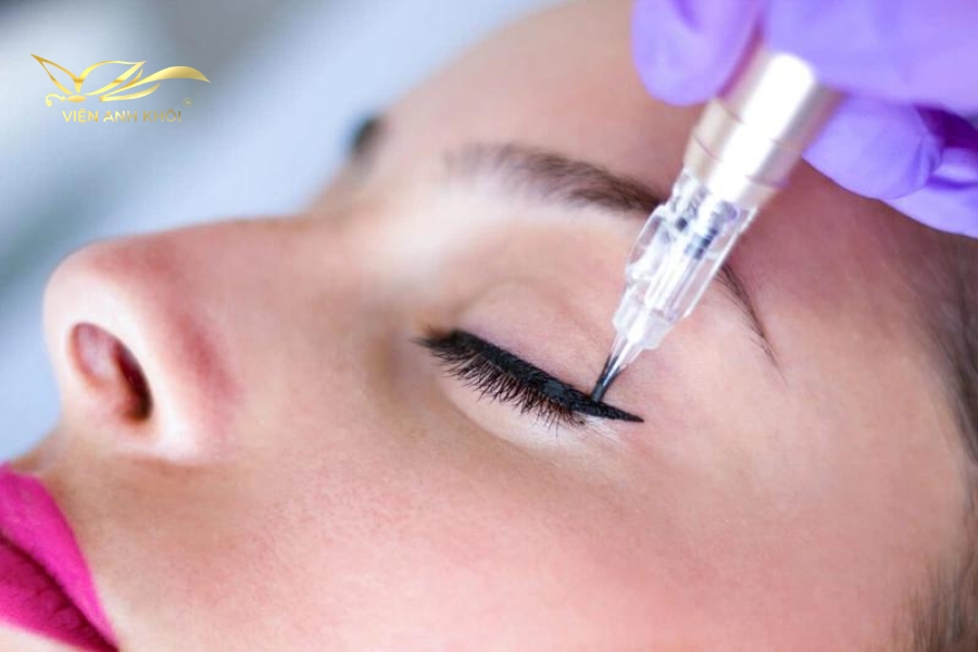 Sử dụng kim nhỏ tiêm mực vào lớp da nông bên trên vùng mí mắt theo thiết kế đã được phác thảo trước đó.