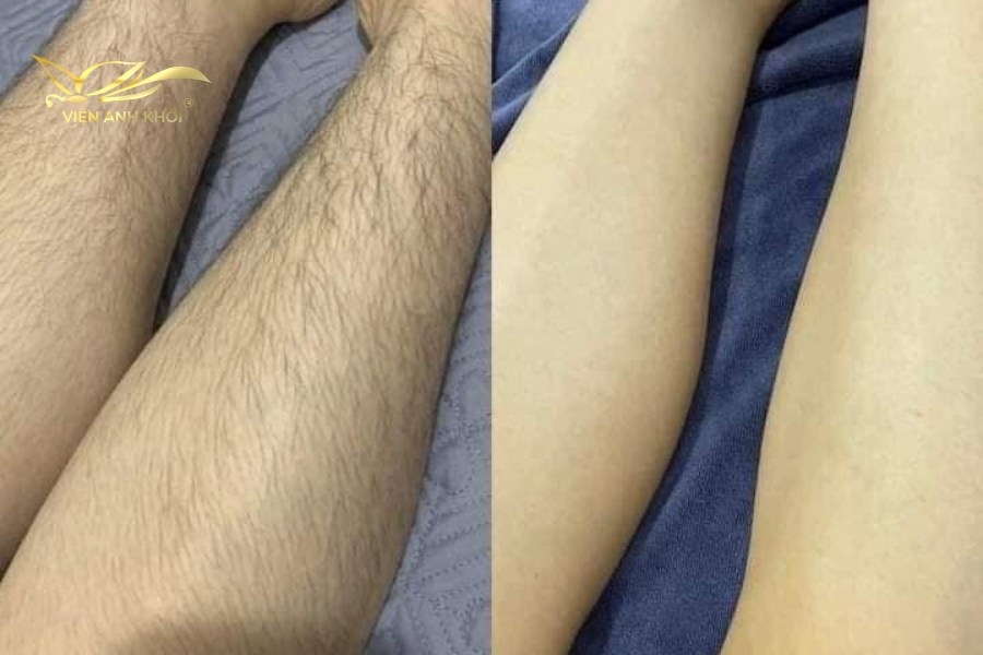 Sự khác nhau giữa chân trước và sau khi triệt lông.