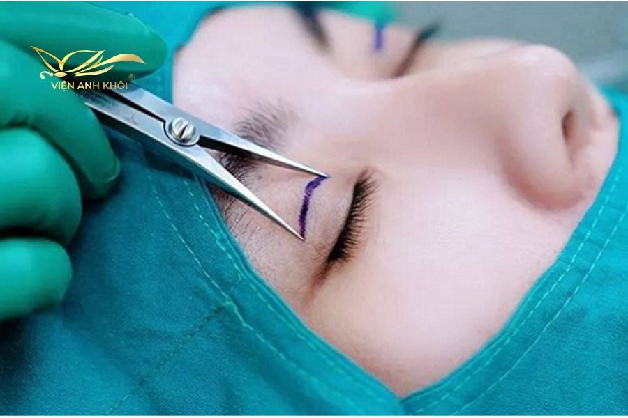 Phương pháp cắt mí mắt mang lại hiệu quả 