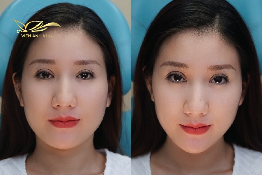 Tiêm botox gọn hàm vào bên trong cơ cắn có tác dụng thon gọn hàm, tạo đường viền hàm. Cơ chế hoạt động của hoạt chất botulinum toxin là ức chế dẫn truyền thần kinh, làm nhỏ lại khối cơ cắn ở hai bên góc hàm, giúp mang đến một gương mặt thanh tú và cân đối.