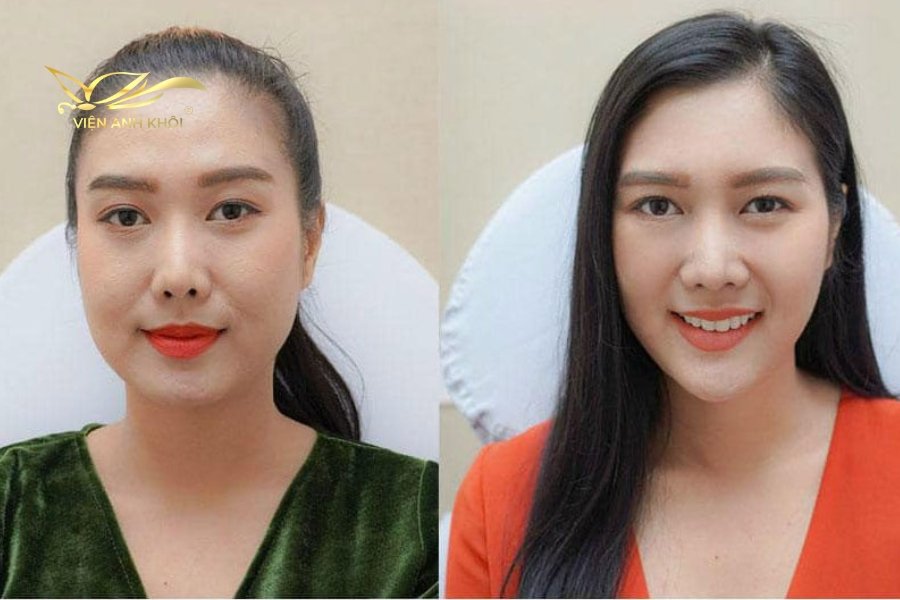 Tạo cằm v-line nhờ tiêm botox thon gọn hàm