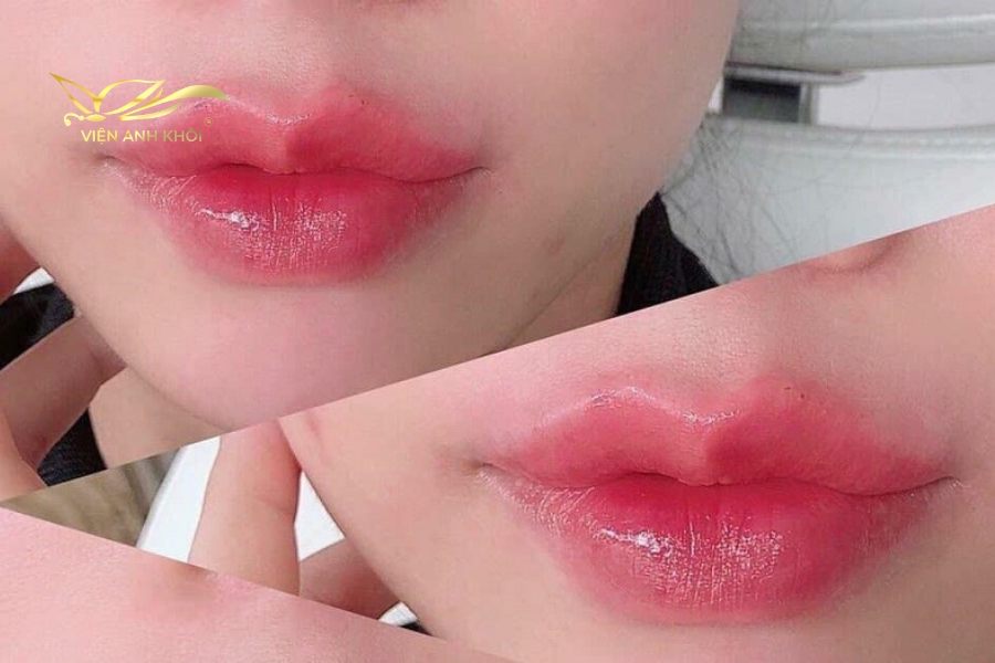 Phun môi hồng san hô kết hợp tiêm filler cho môi căng mọng hồng hào